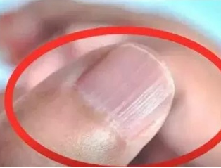 微量元素分析仪厂家分析手指甲有竖纹的根本原因 微量元素分析仪厂家分析手指甲有竖纹的根本原因